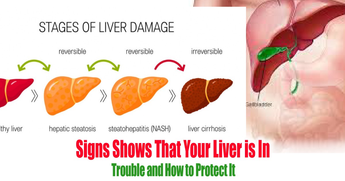 Signs Shows That Your Liver Is In Trouble And How To Protect It 